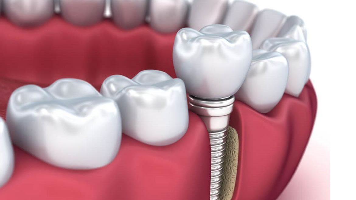 Implantes